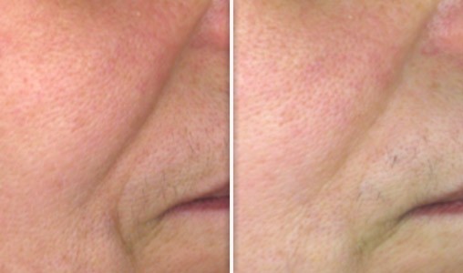 resultat lift essentiel spa