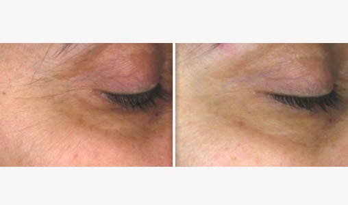 resultat lift essentiel spa
