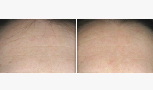 resultat lift essentiel spa