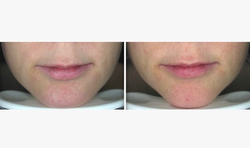 resultat lift essentiel spa