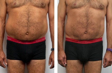 resultat cellulite essentiel spa
