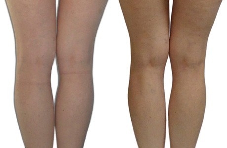 resultat cellulite essentiel spa